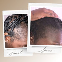 Avant après Kaylabé montrant l’évolution des tempes et d’une zone clairsemée sur cheveux crépus