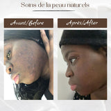 Savon noir pour peaux grasses et acnéiques - Solution naturelle et efficace